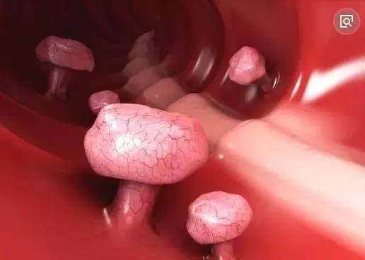 肛肠息肉摘除会怎样,小儿直肠息肉的切除手术