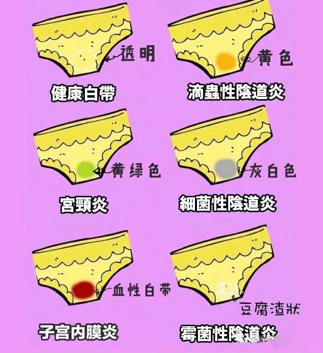 念珠菌性阴道炎症状会怎么样,阴道炎的症状预防