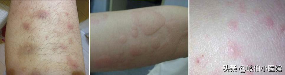 胰岛素怎样注射及剂量,常用胰岛素的注射部位及注意事项