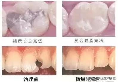 看牙是个漫长痛苦的过程,你以为的看牙费用vs实际看牙费用