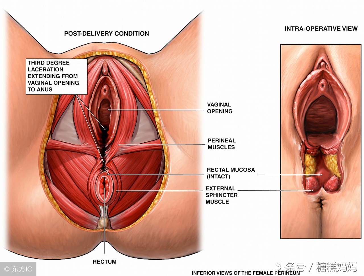 顺产怎样避免被侧切,顺产侧切20天了伤口还疼怎么回事
