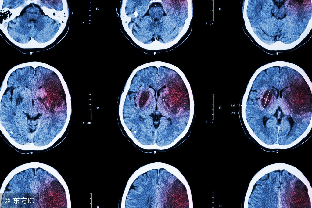 脑堵塞和脑出血哪个严重,脑溢血和脑血栓症状有什么区别