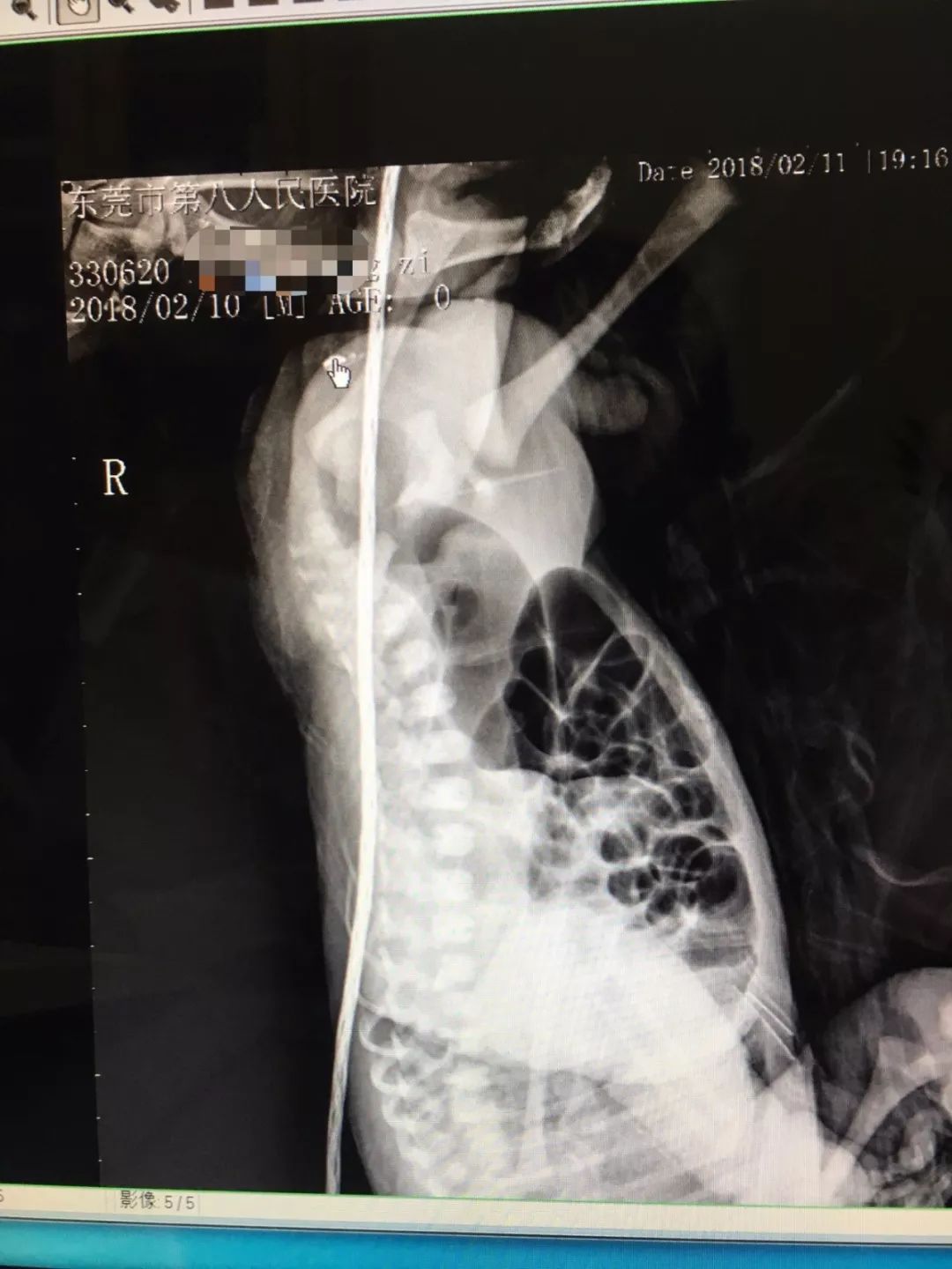 刚生下的男婴没肛怎么办,出生的孩子无肛直肠瘘