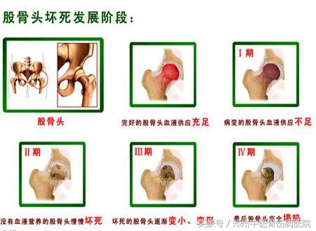 股骨头坏死与坐骨神经痛症状区别,股骨头坏死引起膝关节什么部位痛