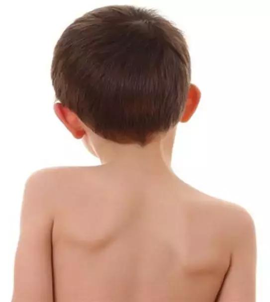 孩子脊柱弯了怎么矫正视频,孩子的脊柱怎么弯