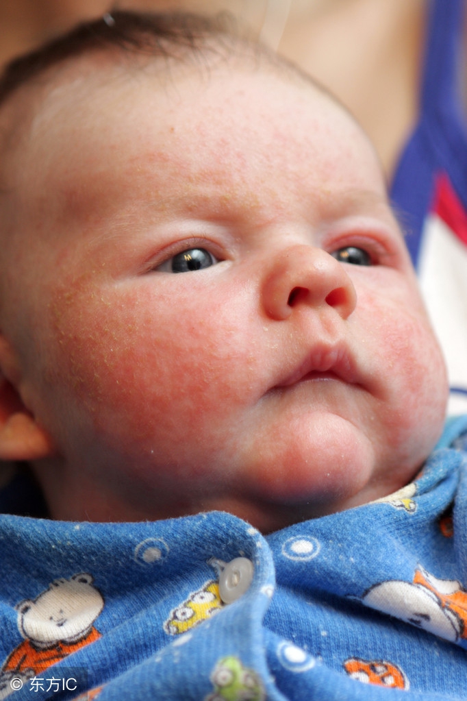 如何判断湿疹还是口水疹,红屁屁还有小红疹怎么护理好得快