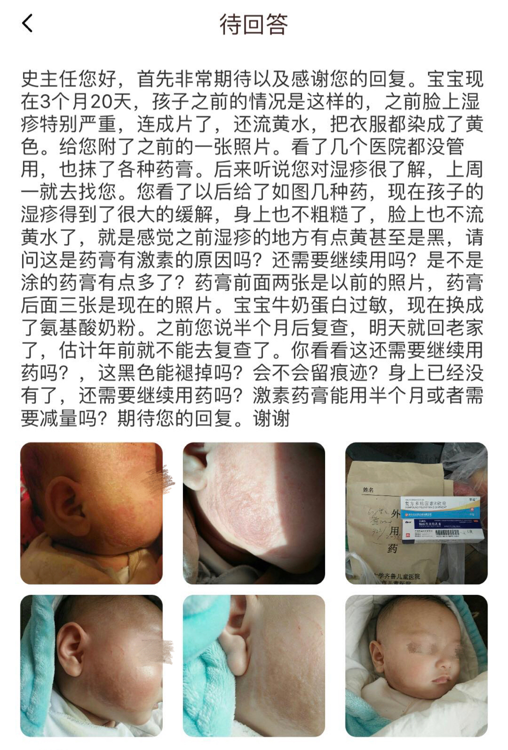 湿疹多久可以消退,湿疹多久退红