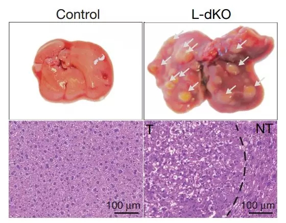 肝癌大突破！拉斯克奖大牛发现全新抑癌蛋白