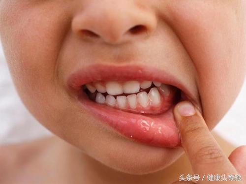 小孩牙齿发黑是不是蛀牙怎么回事,儿童牙齿有点点黑黑的是蛀牙吗