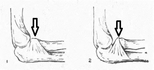 双排牙预防方法,预防孩子双排牙有什么方法