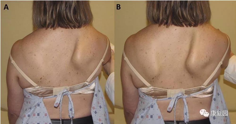 肩峰下撞击综合征的康复评估,肩峰下撞击综合征的康复方法