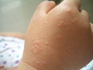 婴儿手指尖突然红肿,3岁宝宝手突然肿的像馒头怎么办