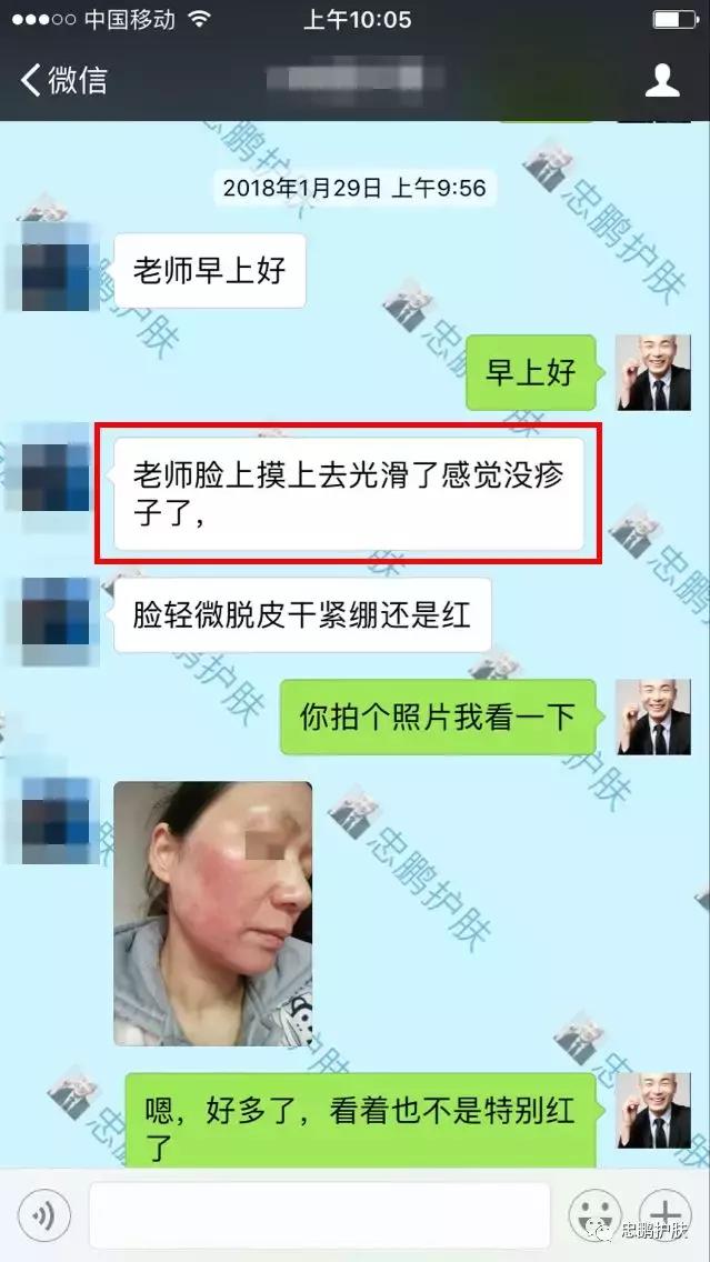 激素脸发红发热脱皮怎么办呢,激素脸为什么会扩散到脖子上代谢