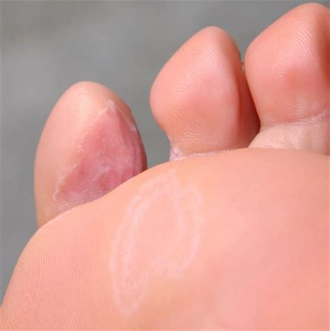 碘伏泡脚治脚气吗,石榴皮泡脚治脚气