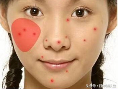 35岁女性脸上反复长痘痘怎么调理,下巴长满痘痘是什么原因怎么调理