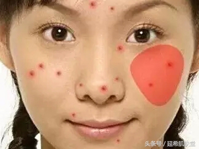 下巴长满痘痘是什么原因怎么调理,下巴不停冒脓包型痘痘怎么样调理