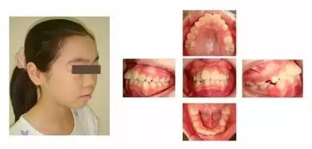 双胞胎连牙齿都一模一样,双胞胎牙齿拥挤错位