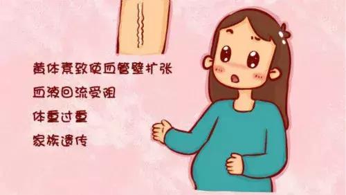 静脉曲张孕期需要注意什么,孕期打静脉曲张的针