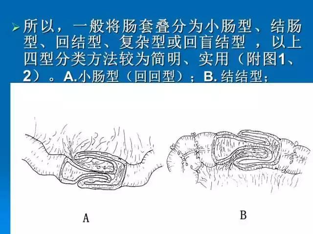 儿童肠套叠空气灌肠后遗症,儿童肠套叠空气灌肠复发几率高吗