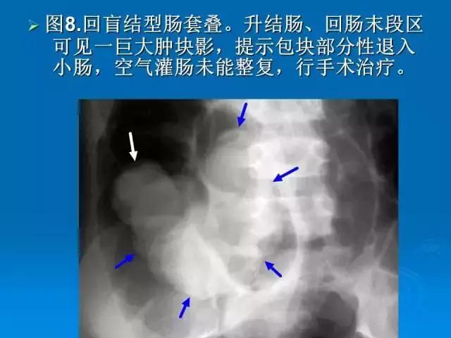 小儿肠套叠空气灌肠需要注意事项,儿童肠套叠空气灌肠要不要住院