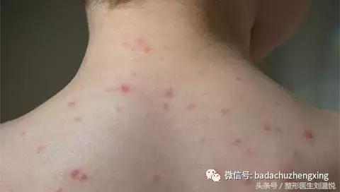 孕期长水痘怎么止痒,孕早期水痘怎么止痒
