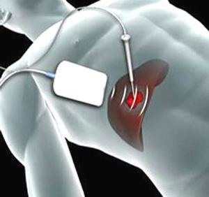 癌症在医院如何选择医生,癌症病人怎么选择放疗还是化疗