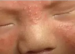 月嫂育婴师新生儿黄疸护理方法,月嫂怎样护理生理性黄疸