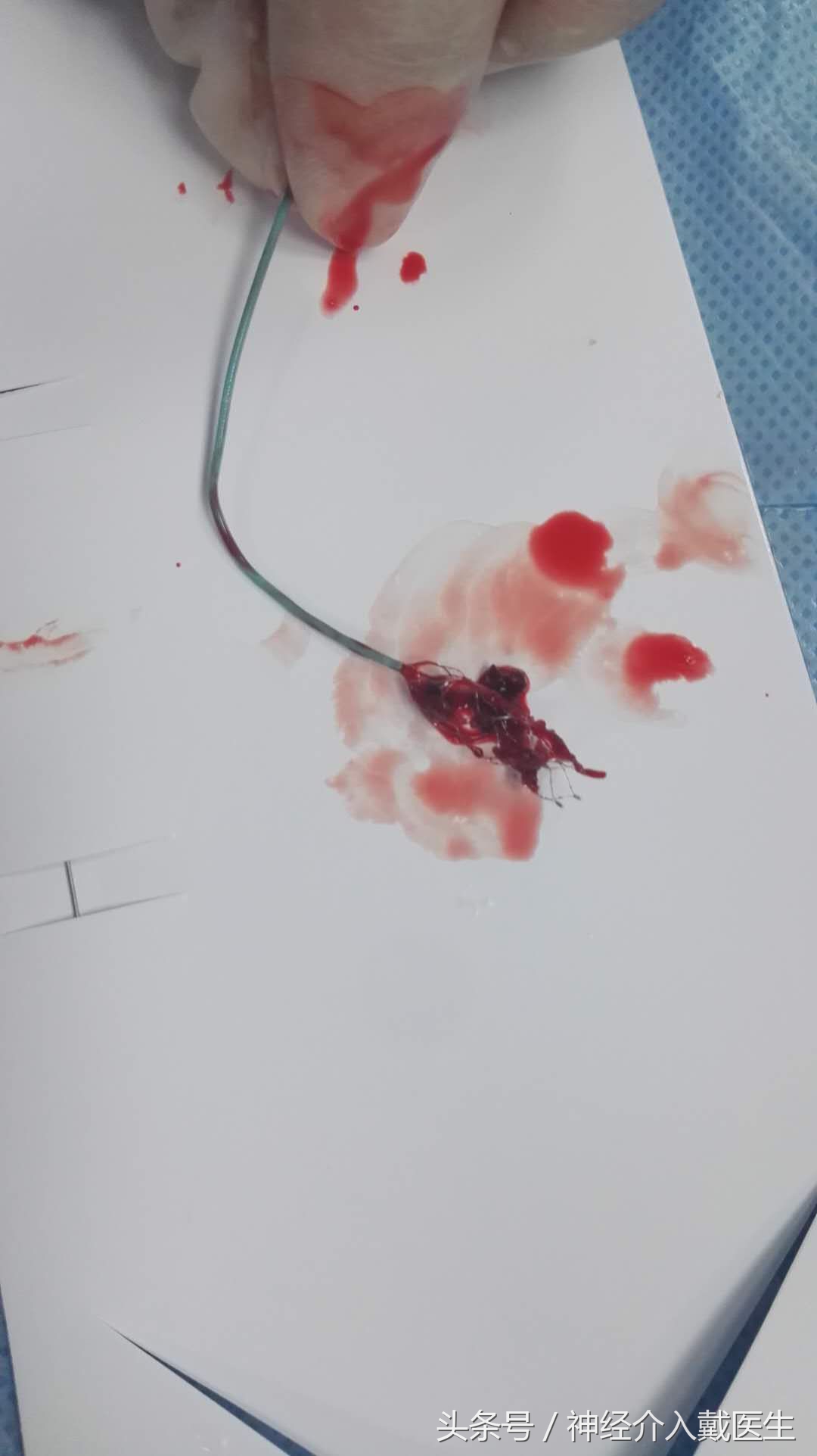 缺血性脑卒中的治疗方法有三类,缺血性脑卒中的治疗方法