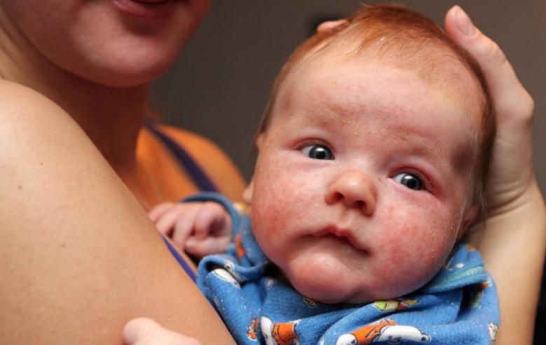 尿布疹皮炎发痒怎么治疗,娃脸上和屁股上湿疹反复发作