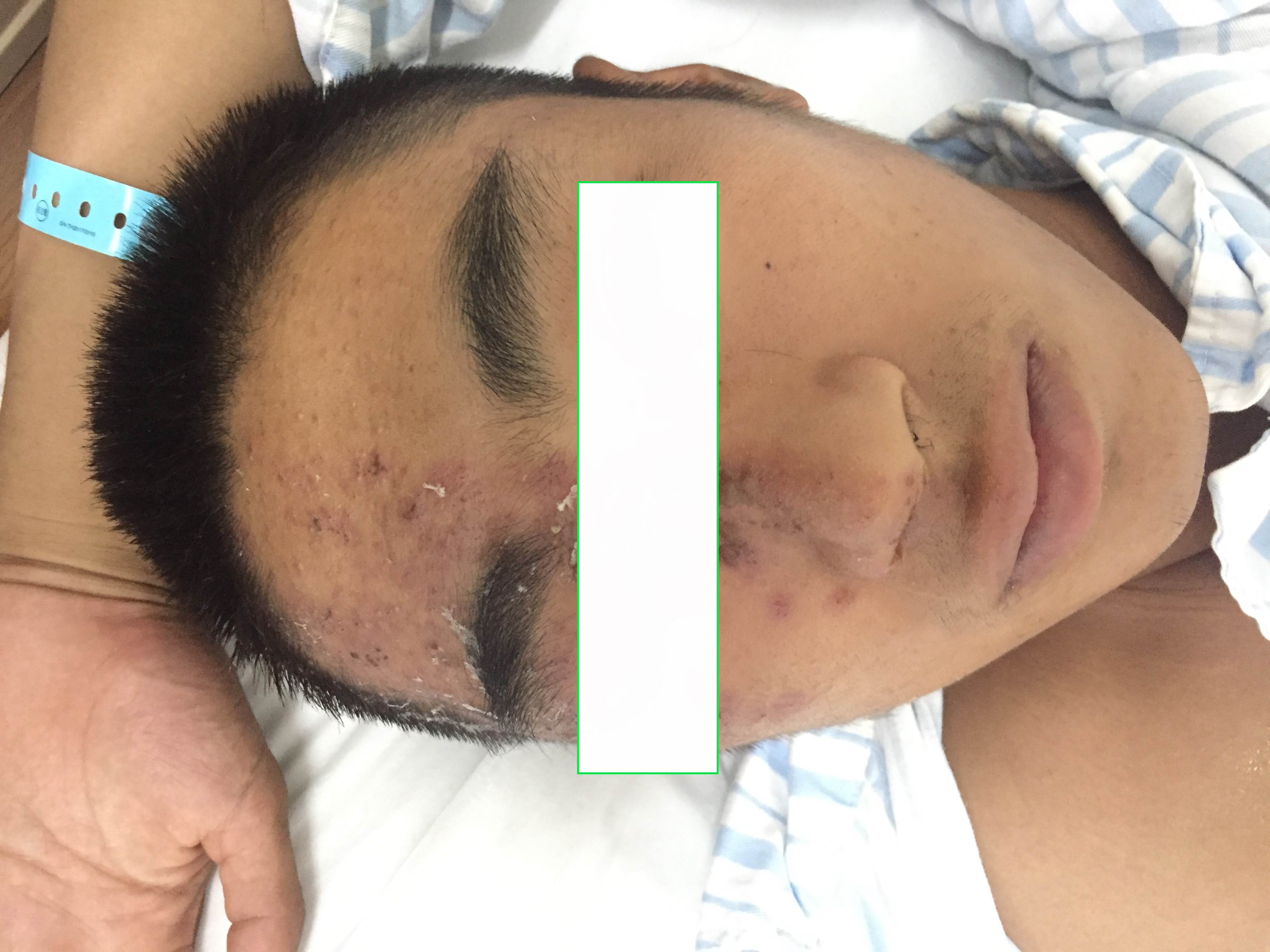 带状疱疹眼睛疼多久能好,眼带状疱疹对眼睛的影响