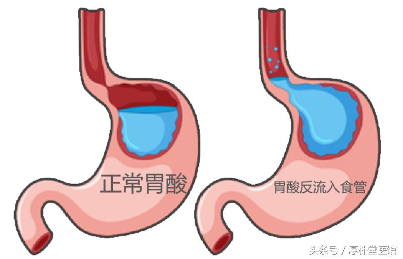反流性食管炎会不会导致ca724升高,反流性食管炎如何迅速缓解