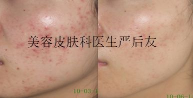 皮肤科修复痘坑大全,痘印痘坑修复皮肤科医生