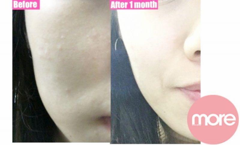 娥罗纳英祛痘印效果好吗,娥罗纳英软膏可以去黑头吗