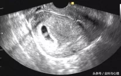 12周先兆流产保胎要卧床多久,有胎心胎芽先兆流产保胎成功率