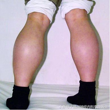 良性肌营养不良自愈的奇迹,进行性肌营养不良分型图表