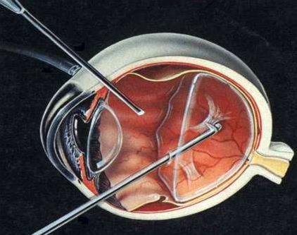 视网膜脱落是最严重的眼科疾病吗,视网膜脱落怎么预防应该注意什么