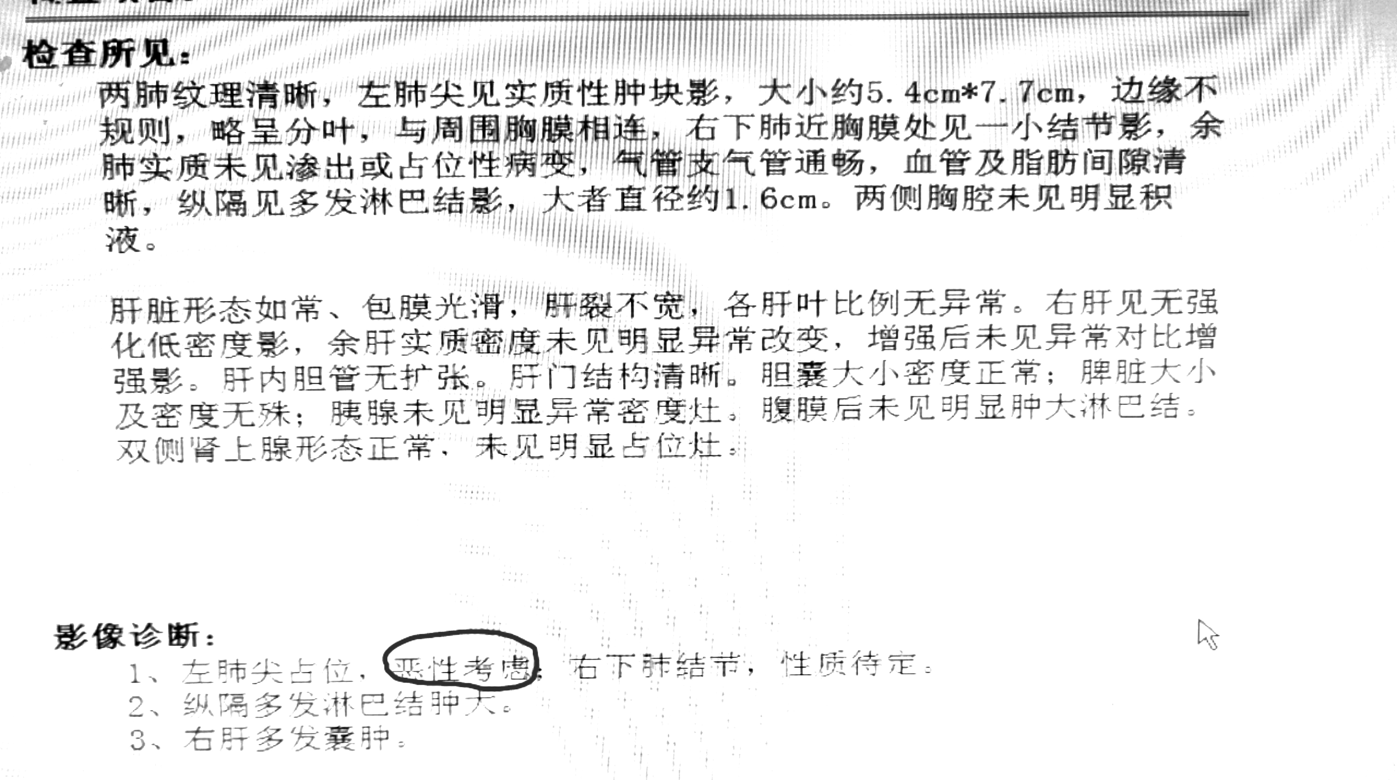 petct诊断癌症有误诊吗,petct提示癌就是癌了吗