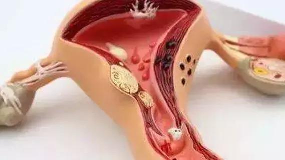 大网膜宫外孕太少见，医生找了好久才找到！