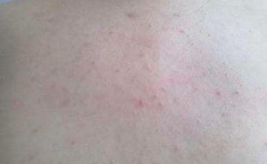 后背长了一个螨虫大疙瘩怎么去除,两天不洗澡就后背长痘痘是螨虫吗