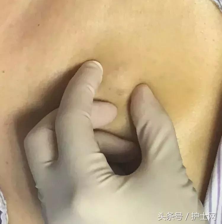 输液港扎针最全示范,输液港拔针的正确方法视频教程