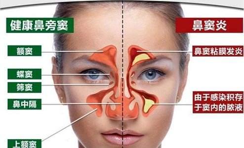 静子谈养生,中医治疗鼻炎方法有哪些