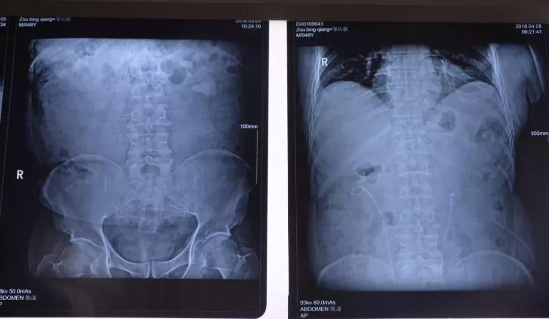 “熊猫血”男子双肾重度积水三次手术零出血解危机