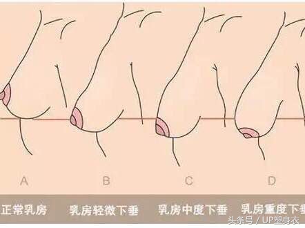预防产后胸部下垂,胸部下垂怎么办只需四招快速解决