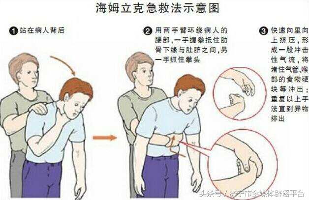 中风头部针刺能自愈吗,中风失语针灸疗法