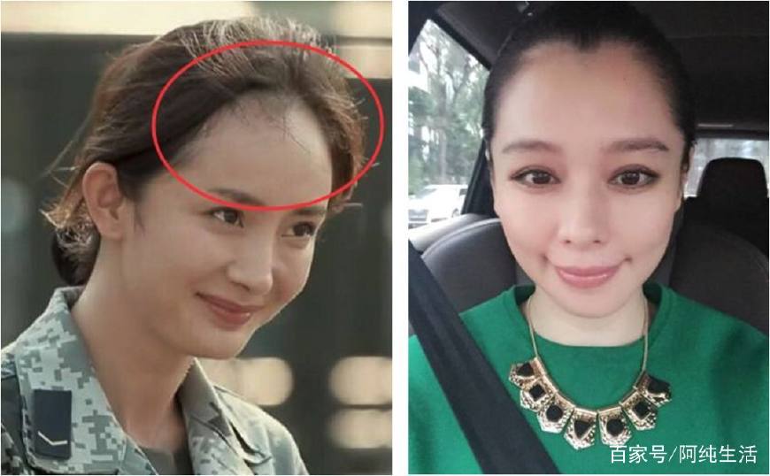 发际线脱发的原因和治疗方法,不要让发际线后移