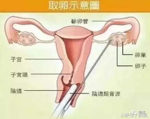 骗女生上床还买卖女生卵子，这些卖卵中介去死吧！