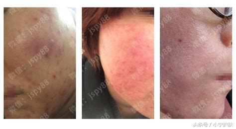 什么是激素脸怎么修复,轻度激素脸和重度激素脸的区别