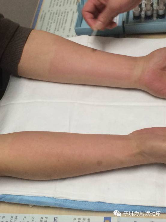 过敏性鼻炎像得了不治之症,过敏性鼻炎是不是什么大病