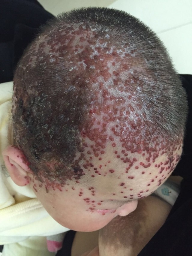 儿童嘴巴长疱疹湿疹,妈妈嘴角长疱疹孩子碰到了