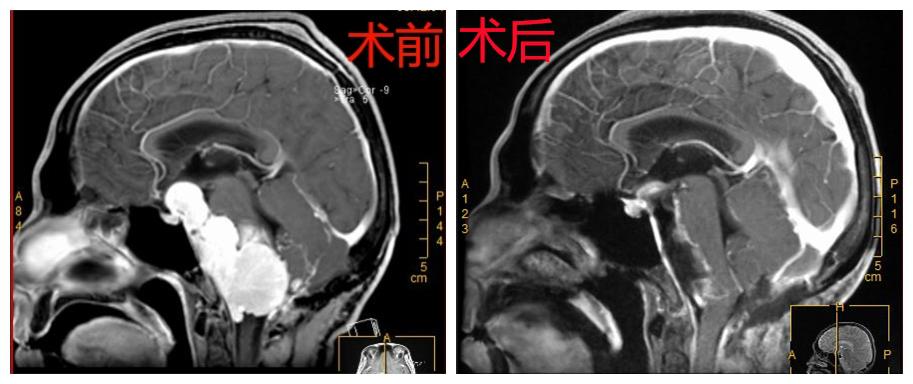 复杂脑肿瘤切除深圳二院脑科中心再创奇迹